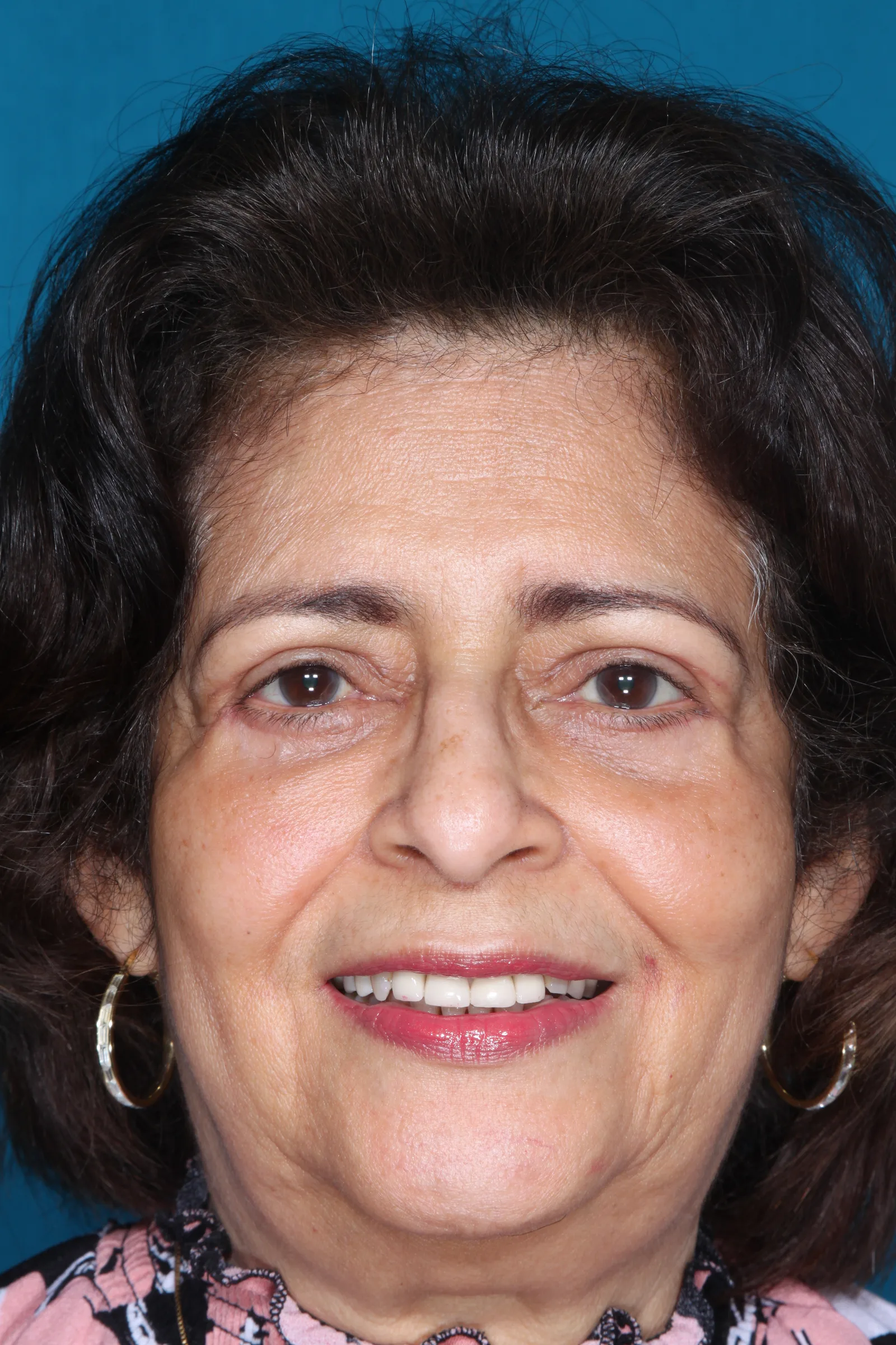 After four-lid blepharoplasty blepharoplasty case 2 at Skin Secrets