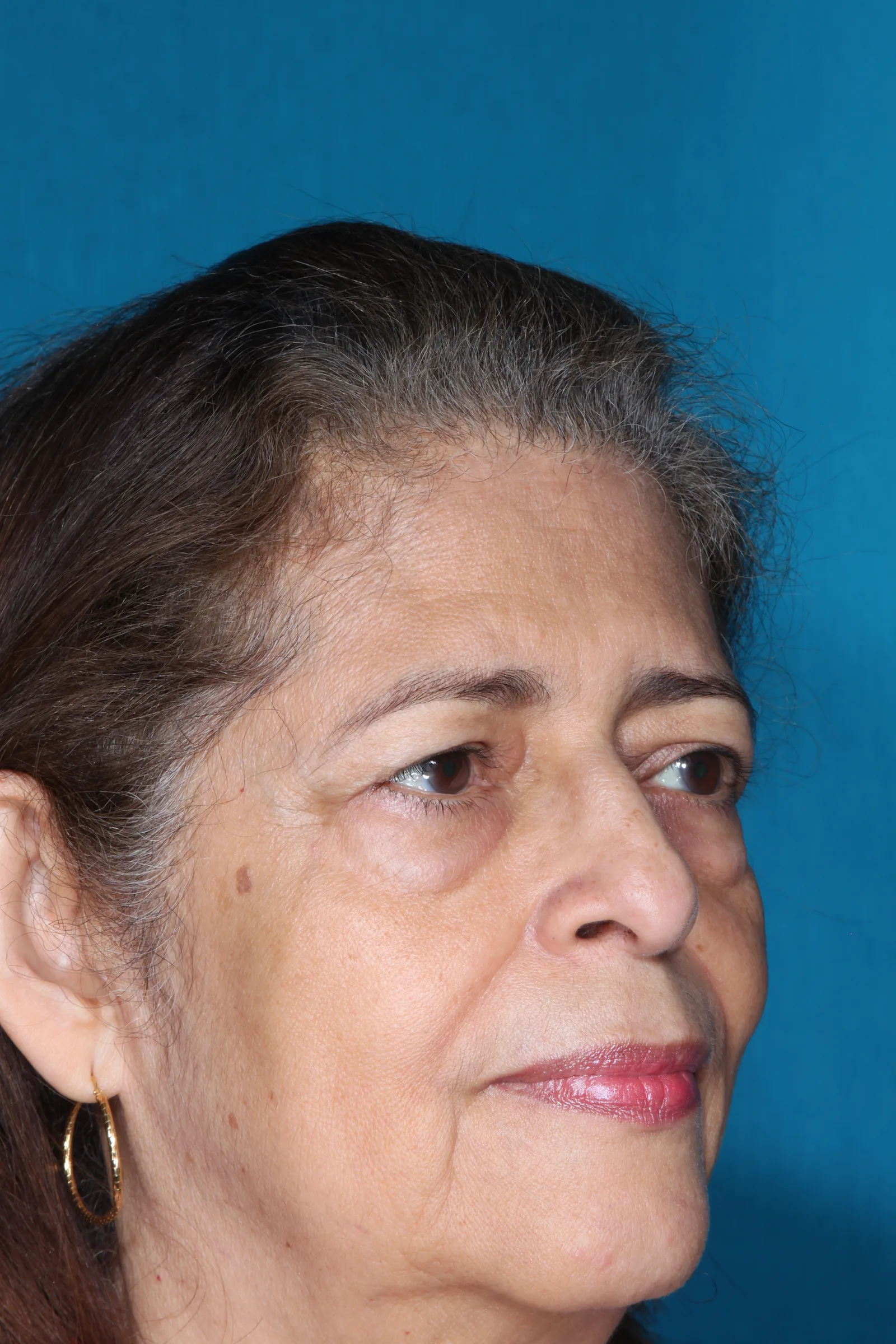 Before four-lid blepharoplasty blepharoplasty case 2 at Skin Secrets