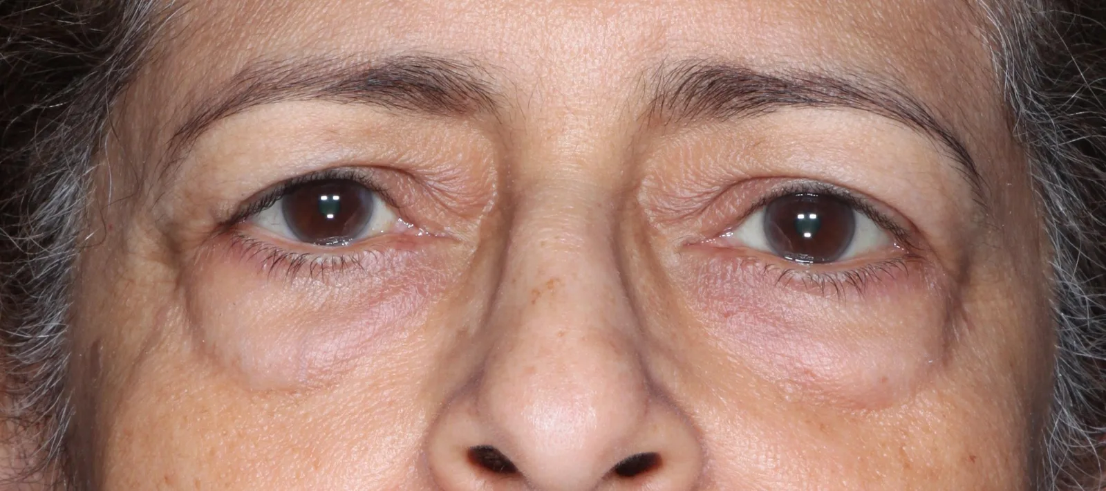 Before four-lid blepharoplasty blepharoplasty case 2 at Skin Secrets