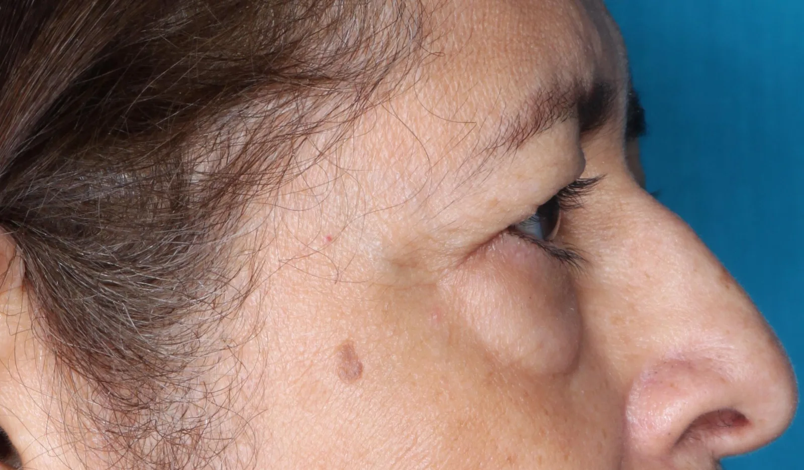 Before four-lid blepharoplasty blepharoplasty case 2 at Skin Secrets