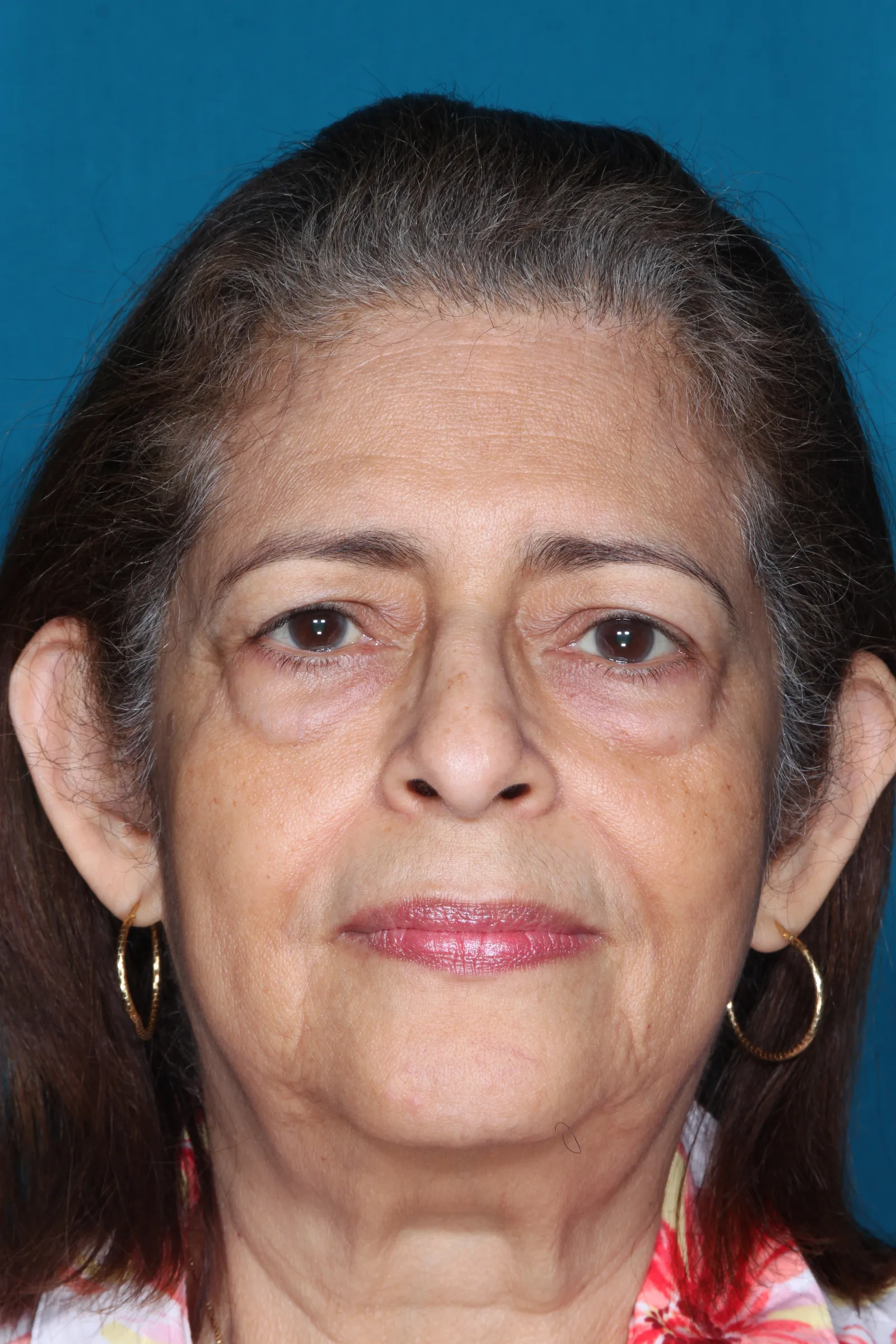 Before four-lid blepharoplasty blepharoplasty case 2 at Skin Secrets