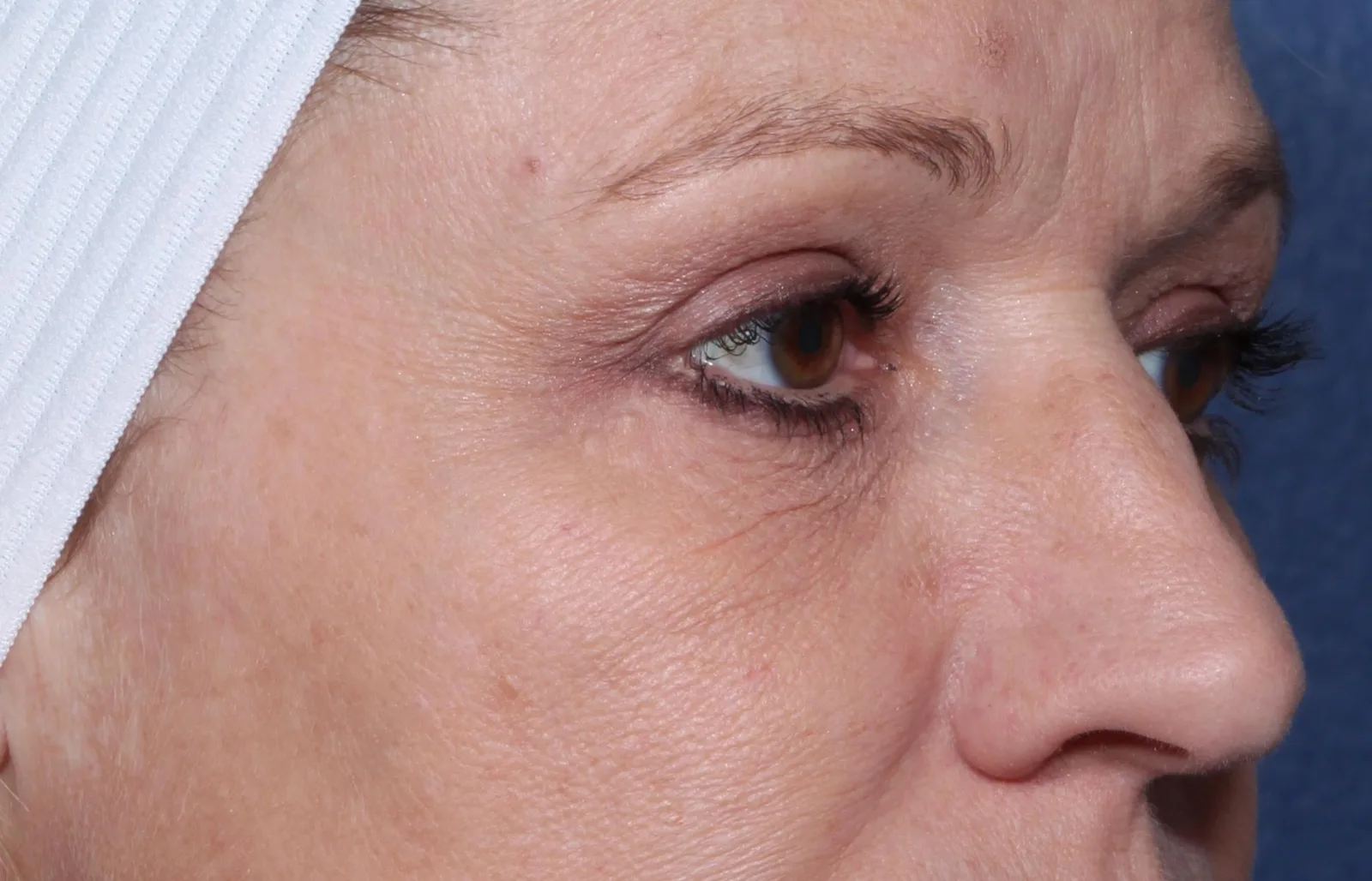 After four-lid blepharoplasty blepharoplasty case 4 at Skin Secrets