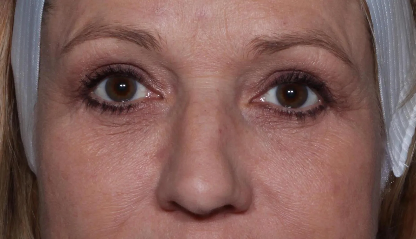 After four-lid blepharoplasty blepharoplasty case 4 at Skin Secrets
