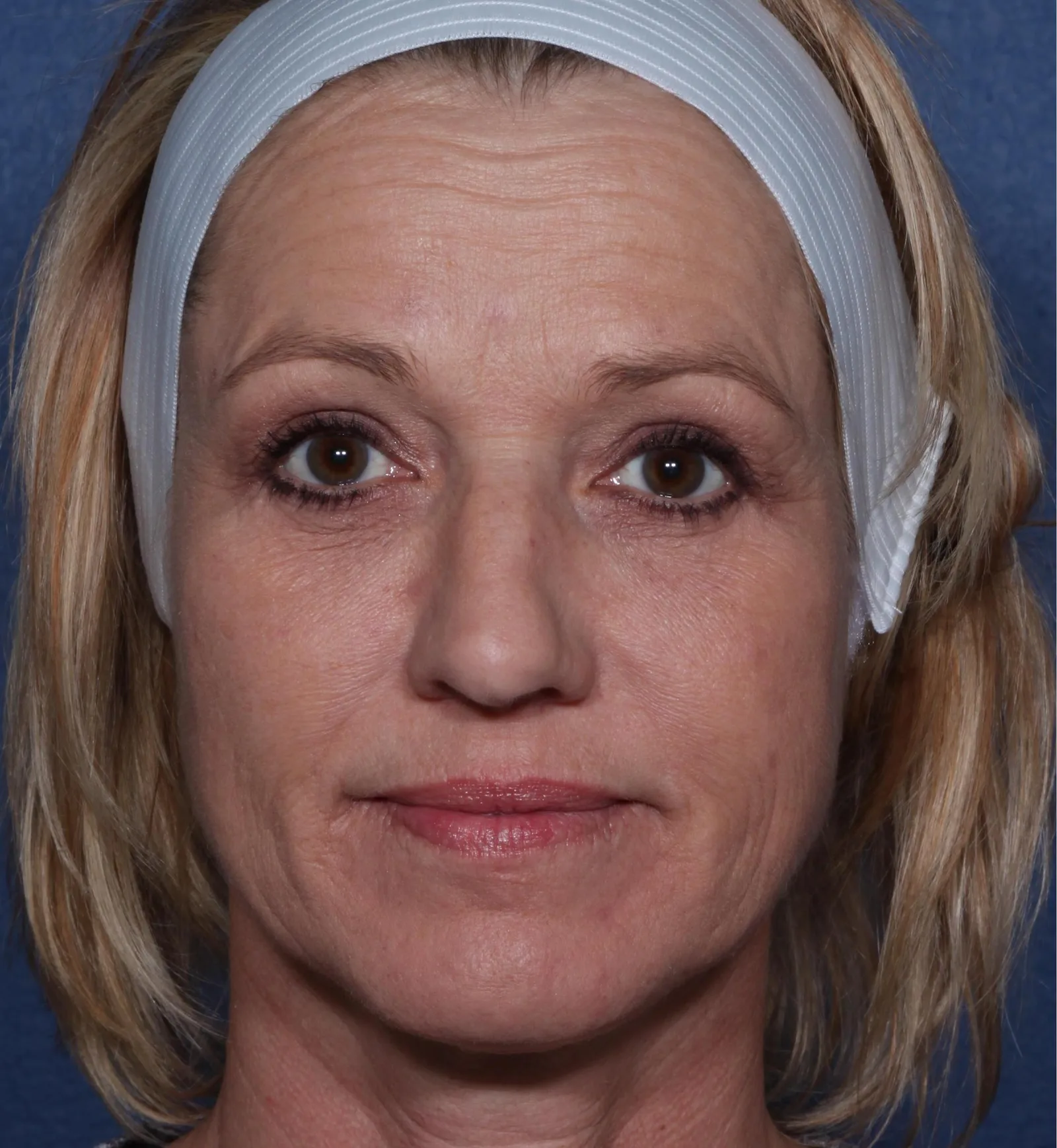 After four-lid blepharoplasty blepharoplasty case 4 at Skin Secrets