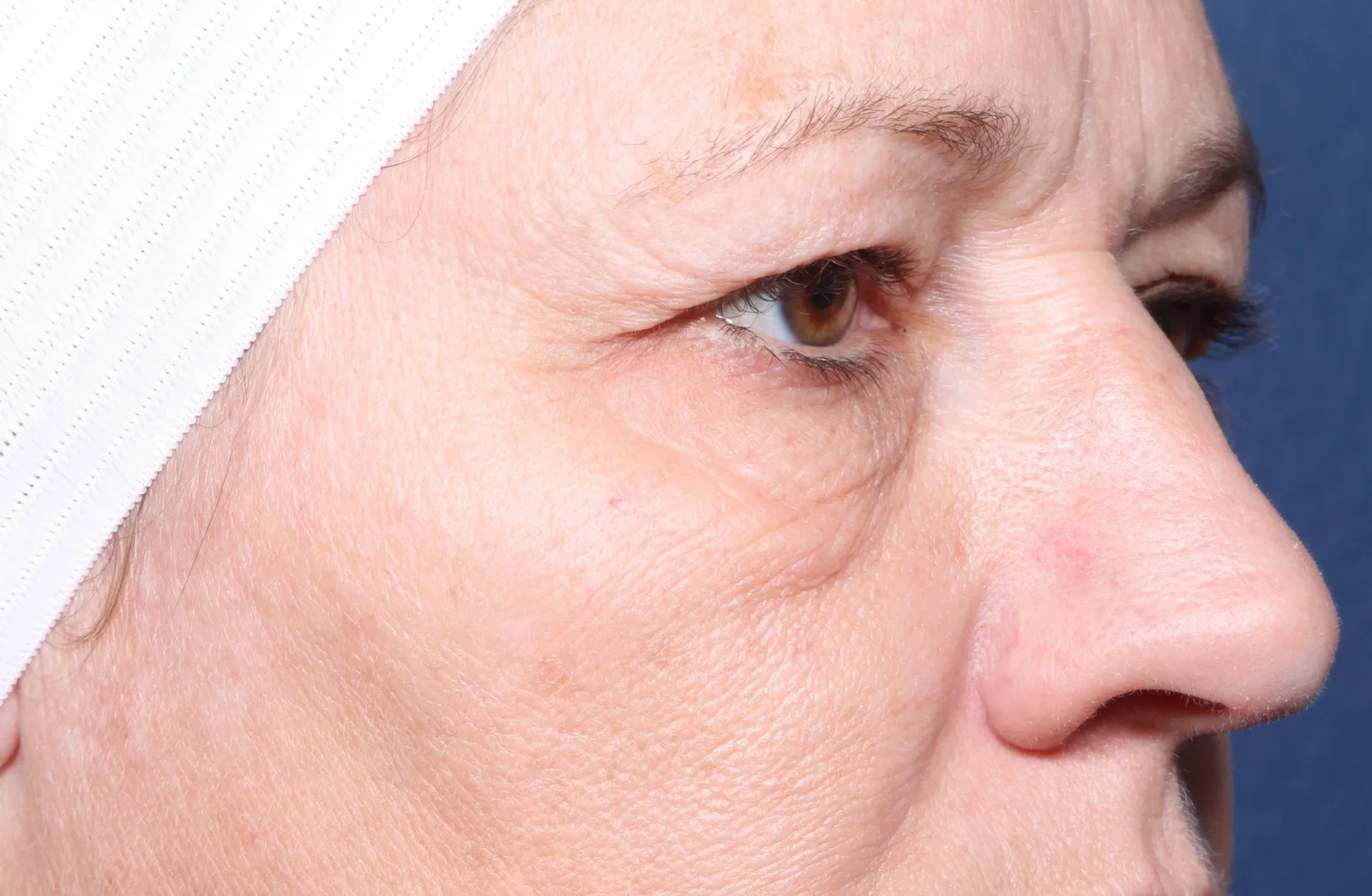 Before four-lid blepharoplasty blepharoplasty case 4 at Skin Secrets