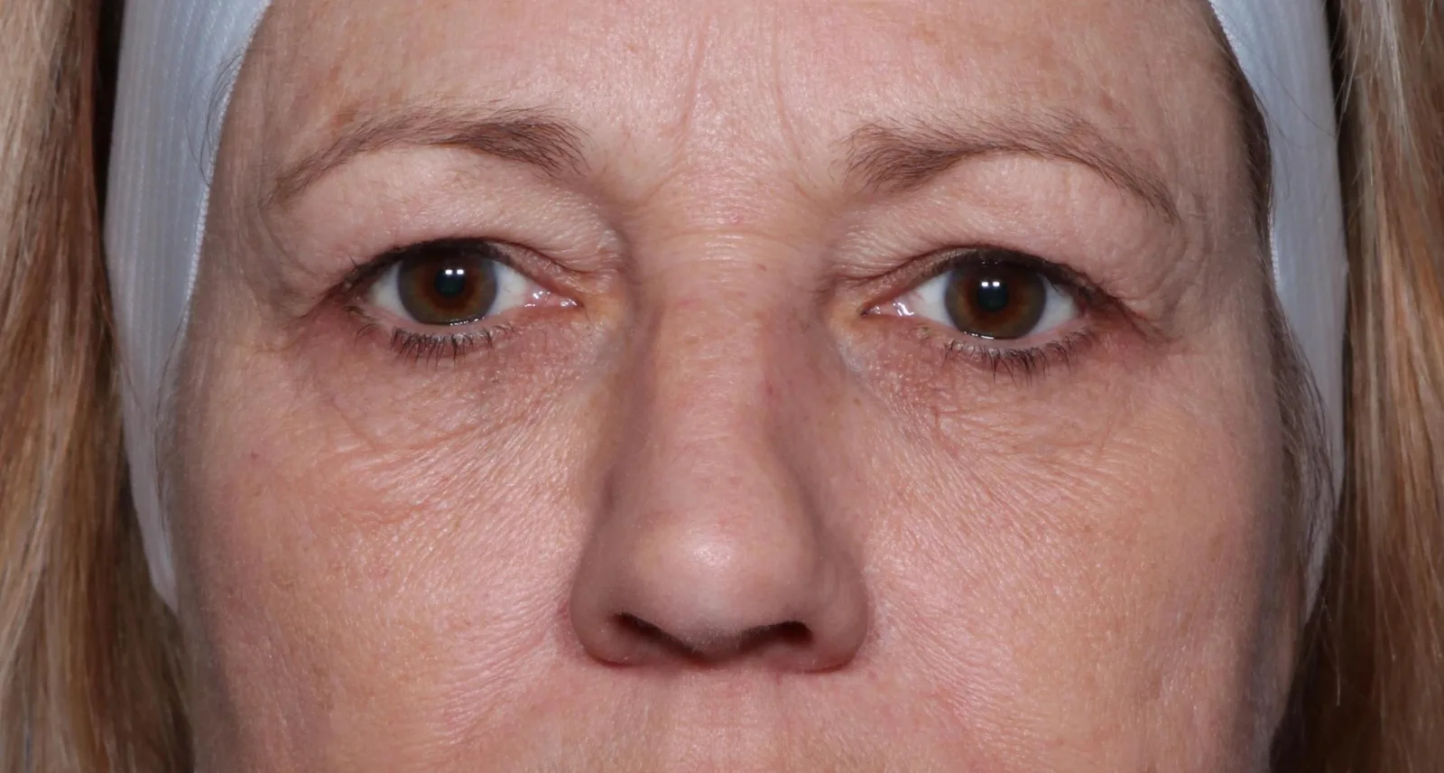 Before four-lid blepharoplasty blepharoplasty case 4 at Skin Secrets
