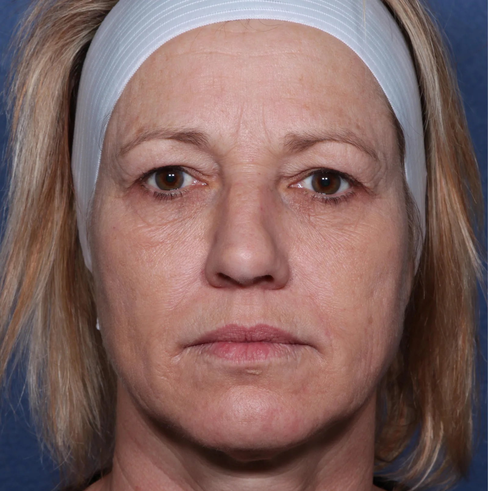 Before four-lid blepharoplasty blepharoplasty case 4 at Skin Secrets