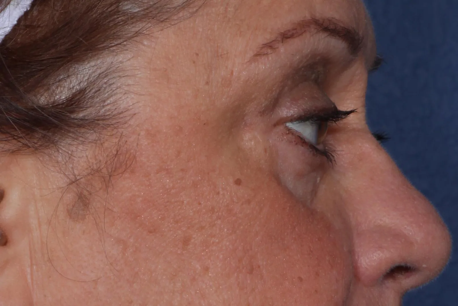 After four-lid blepharoplasty blepharoplasty case 5 at Skin Secrets