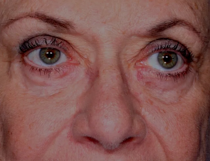 After four-lid blepharoplasty blepharoplasty case 5 at Skin Secrets
