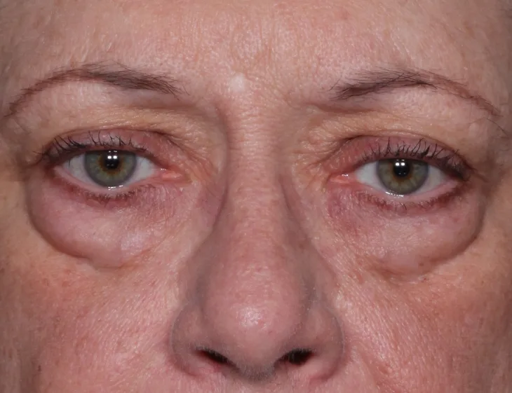 Before four-lid blepharoplasty blepharoplasty case 5 at Skin Secrets