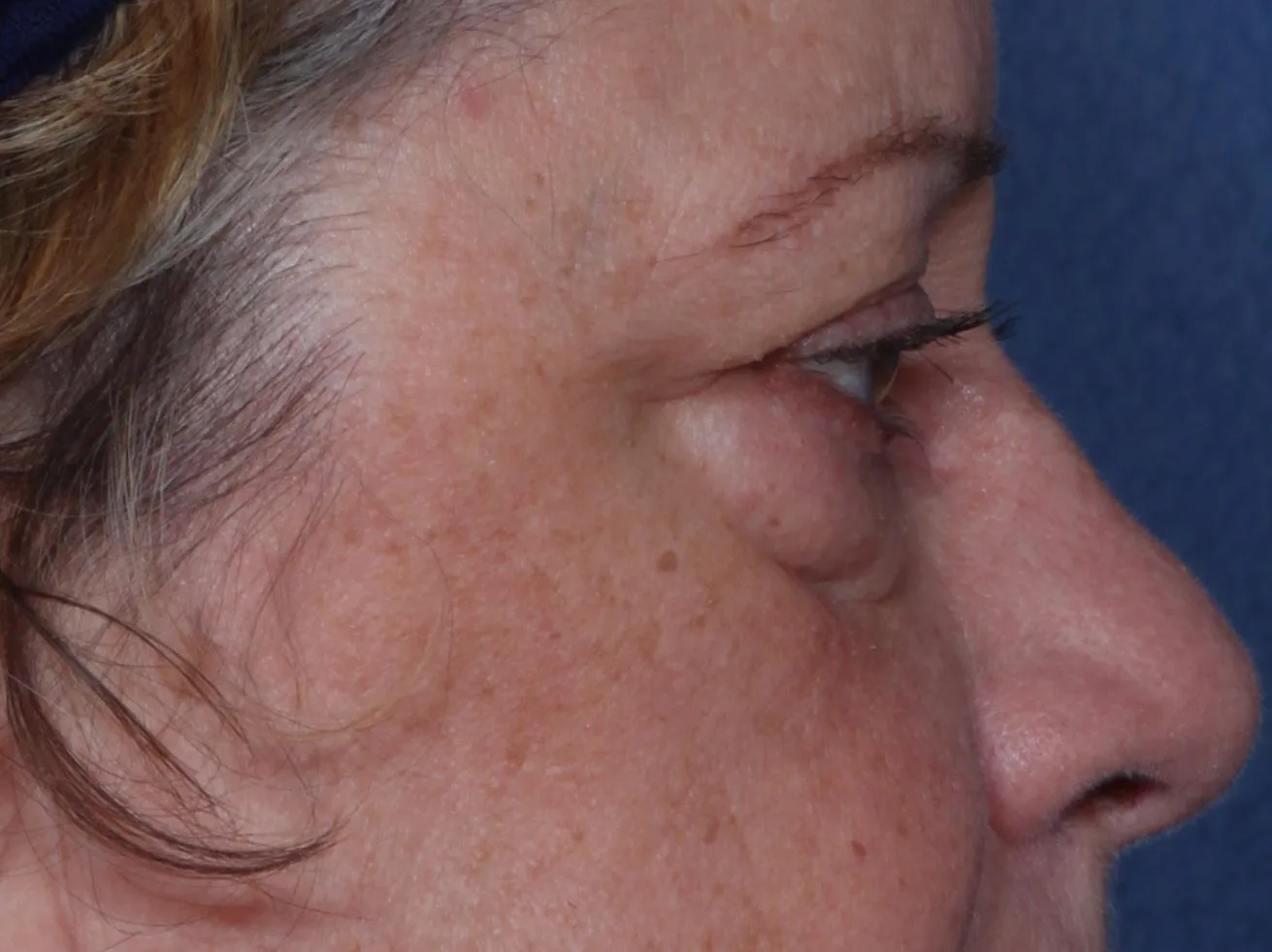 Before four-lid blepharoplasty blepharoplasty case 5 at Skin Secrets