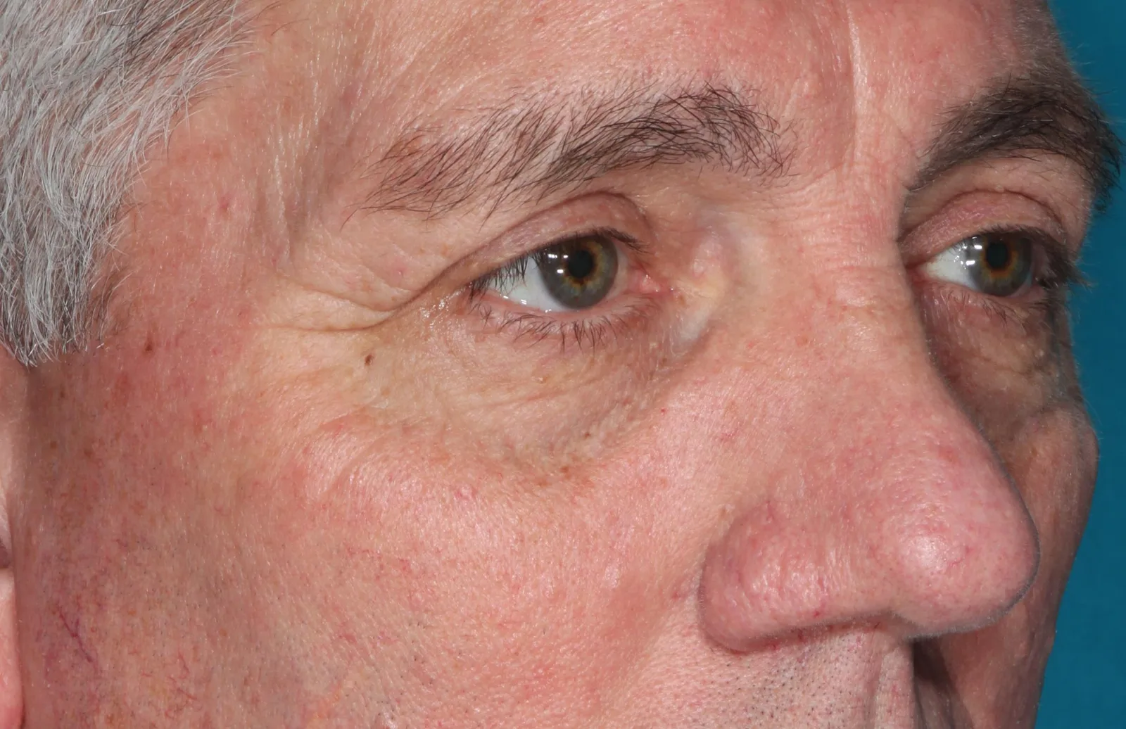 After functional upper lid blepharoplasty case 1 at Skin Secrets