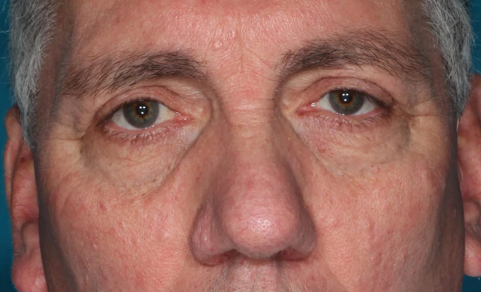 After functional upper lid blepharoplasty case 1 at Skin Secrets