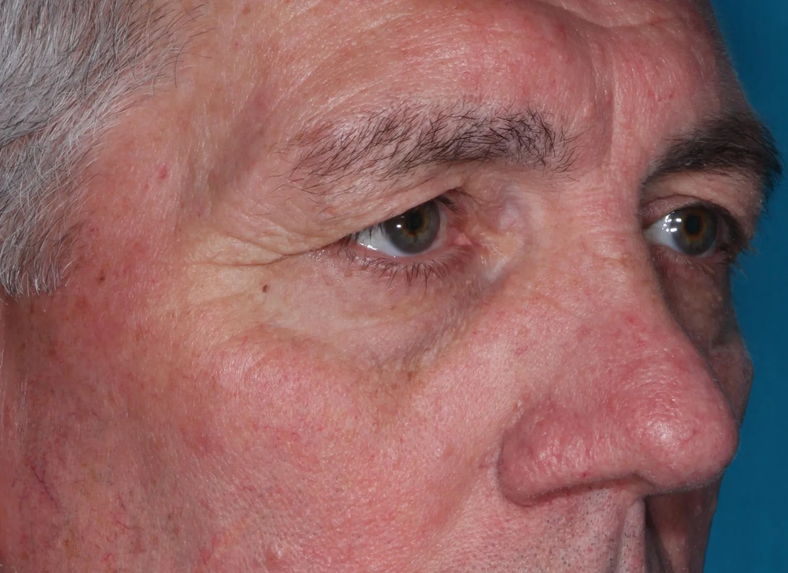 Before functional upper lid blepharoplasty case 1 at Skin Secrets