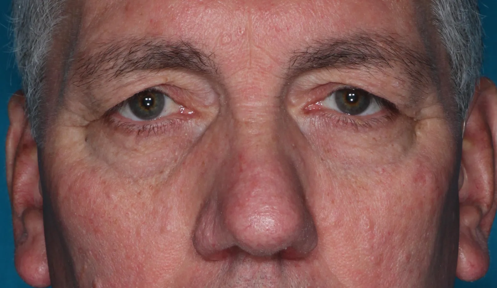 Before functional upper lid blepharoplasty case 1 at Skin Secrets
