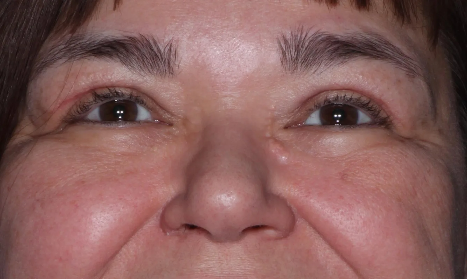 After functional upper lid blepharoplasty case 2 at Skin Secrets