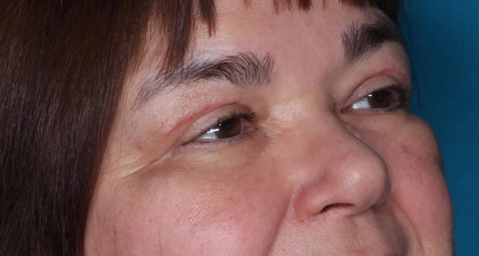 After functional upper lid blepharoplasty case 2 at Skin Secrets