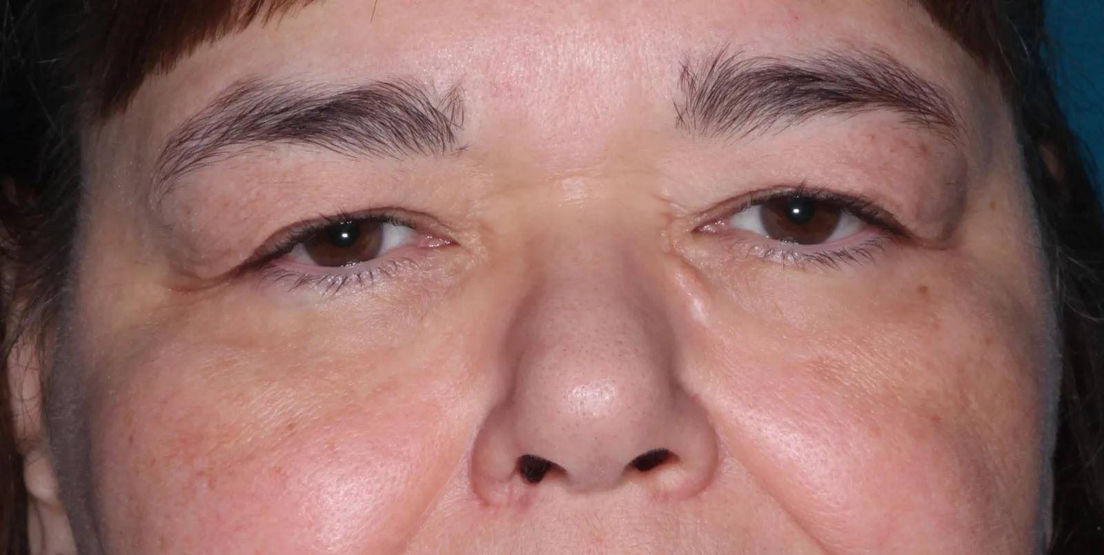 Before functional upper lid blepharoplasty case 2 at Skin Secrets