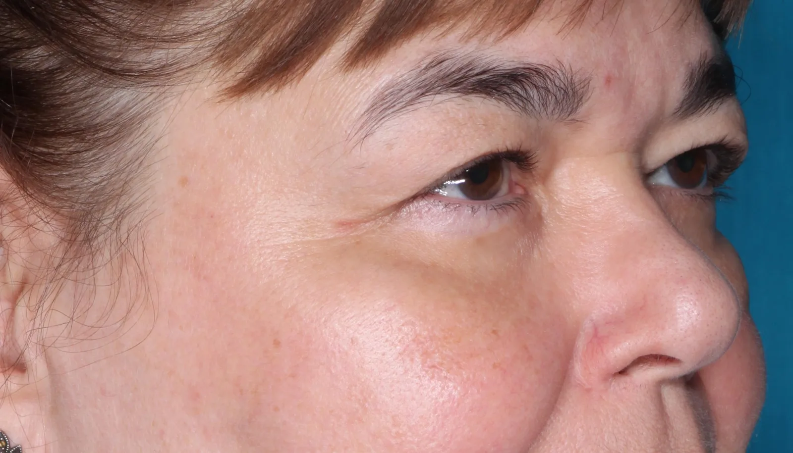 Before functional upper lid blepharoplasty case 2 at Skin Secrets