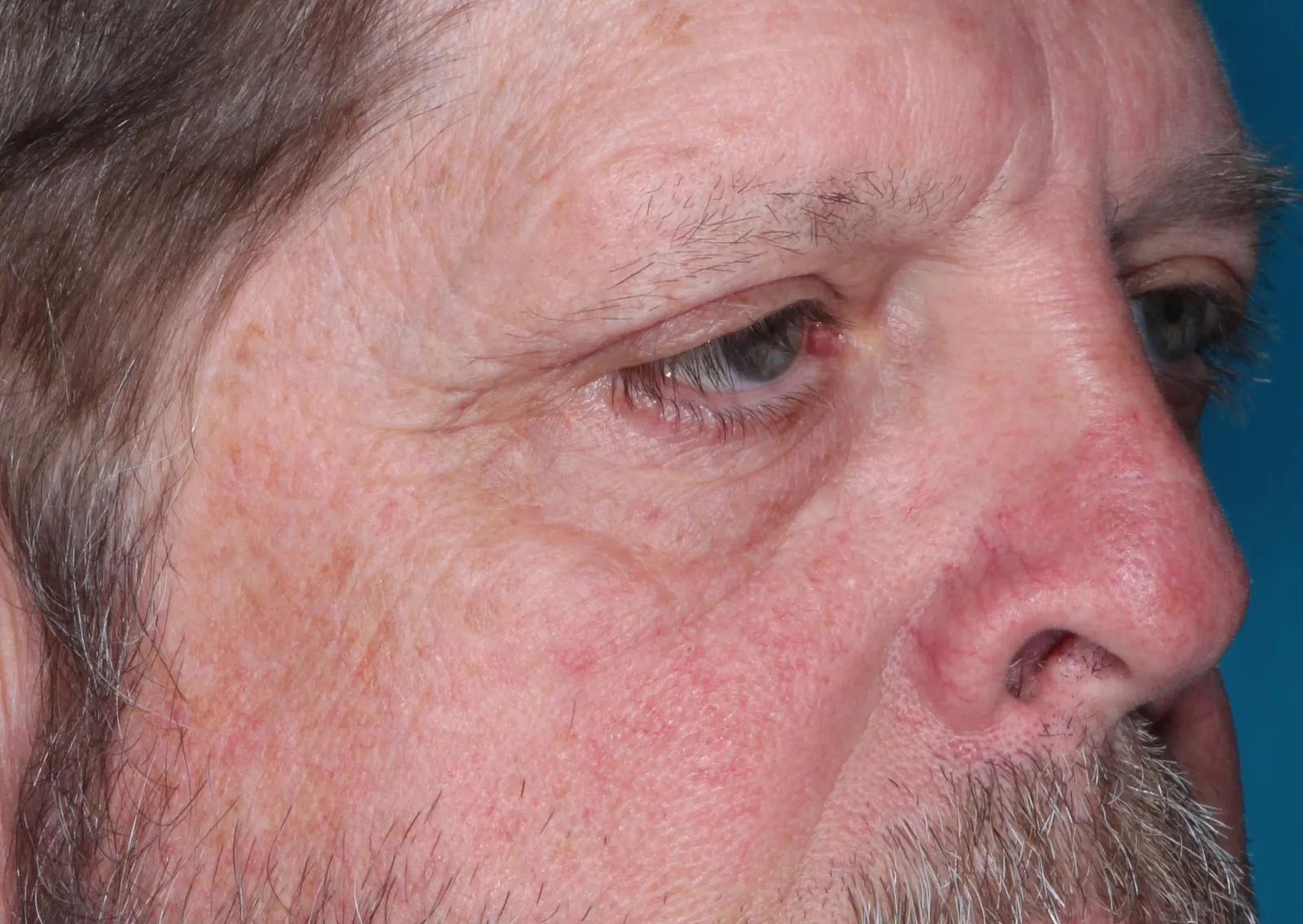 After functional upper lid blepharoplasty case 3 at Skin Secrets
