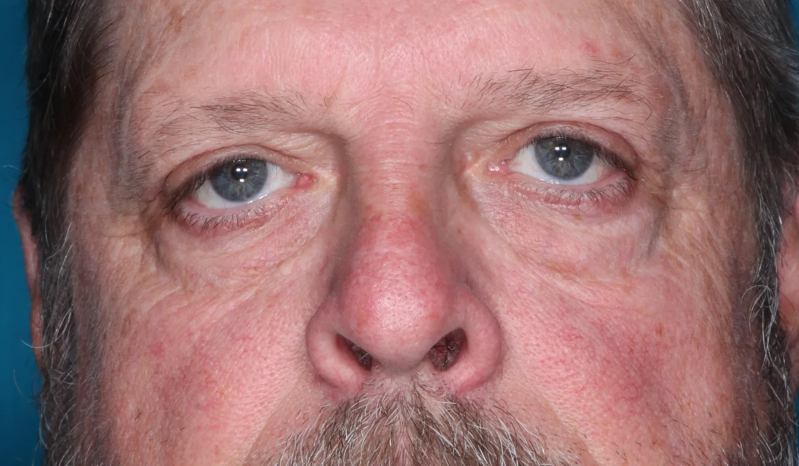 After functional upper lid blepharoplasty case 3 at Skin Secrets
