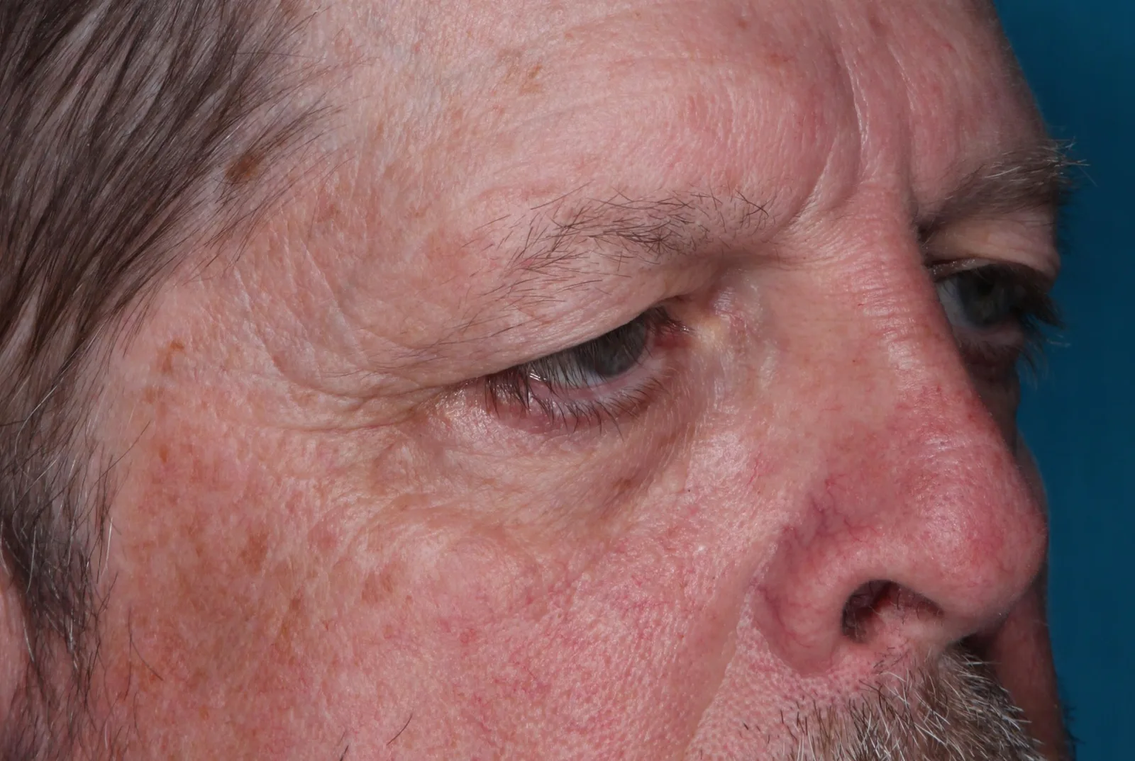 Before functional upper lid blepharoplasty case 3 at Skin Secrets