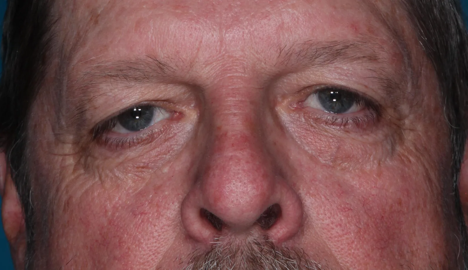 Before functional upper lid blepharoplasty case 3 at Skin Secrets