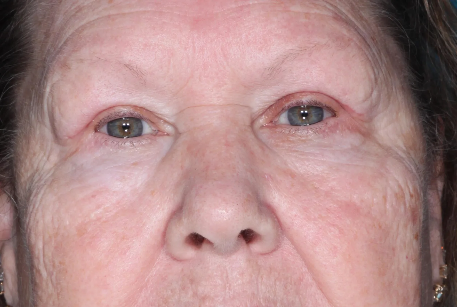 After functional upper lid blepharoplasty case 4 at Skin Secrets