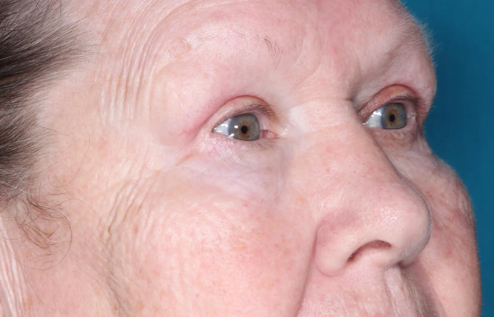 After functional upper lid blepharoplasty case 4 at Skin Secrets