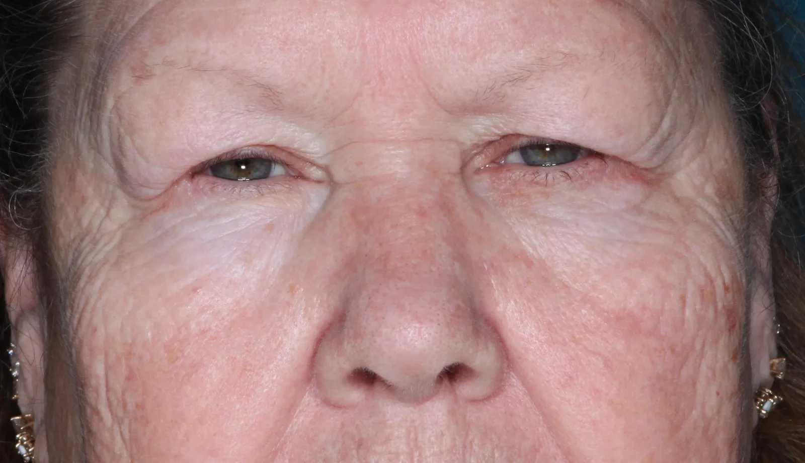 Before functional upper lid blepharoplasty case 4 at Skin Secrets