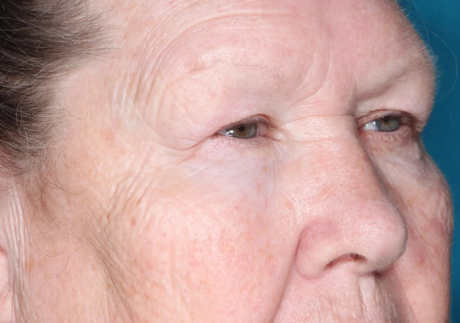 Before functional upper lid blepharoplasty case 4 at Skin Secrets