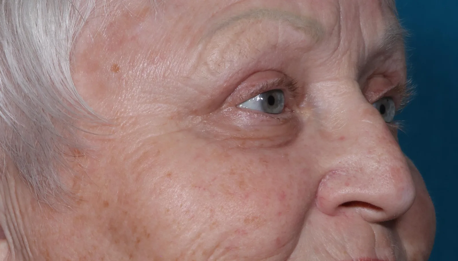 After functional upper lid blepharoplasty case 5 at Skin Secrets