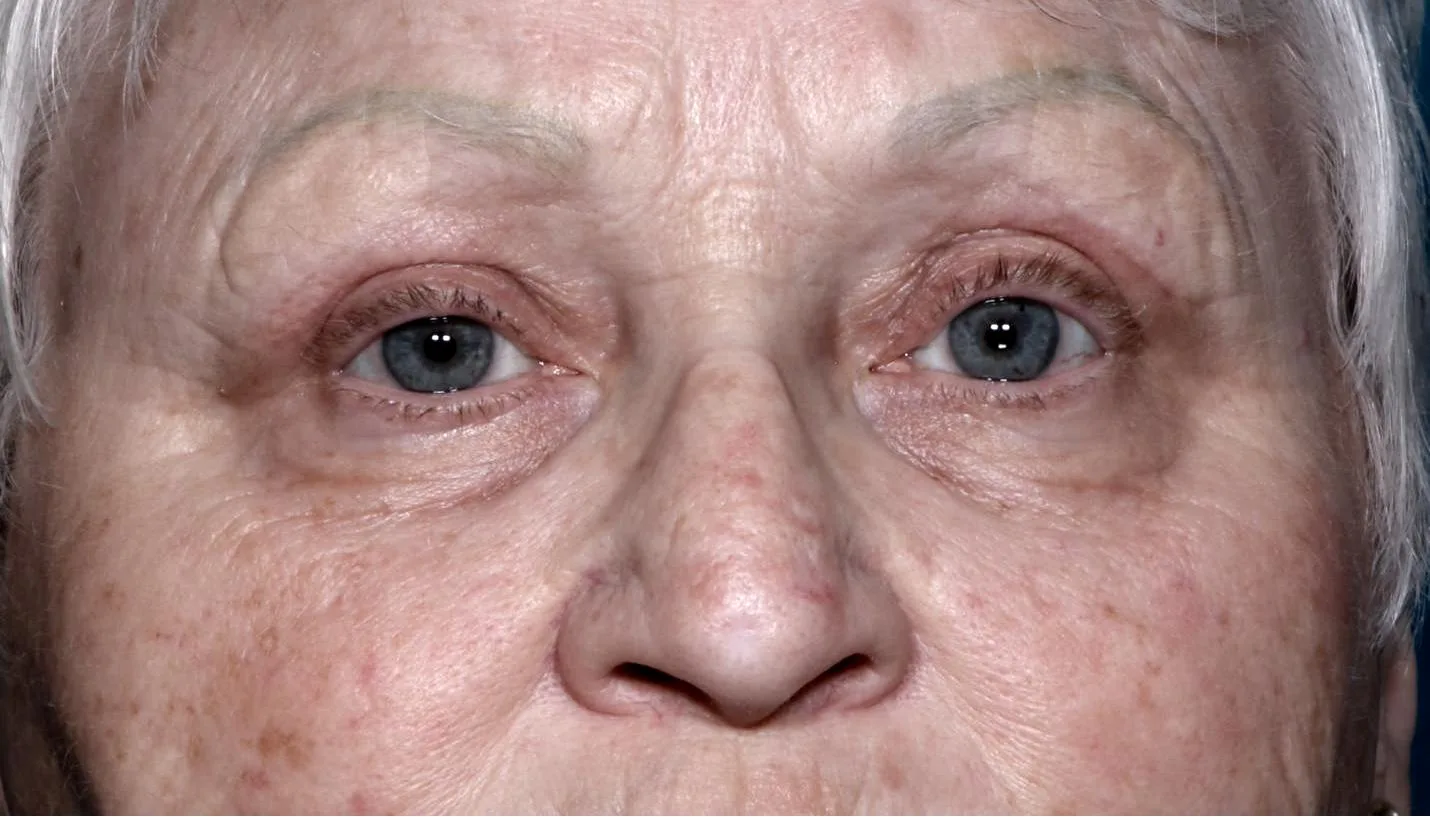 After functional upper lid blepharoplasty case 5 at Skin Secrets