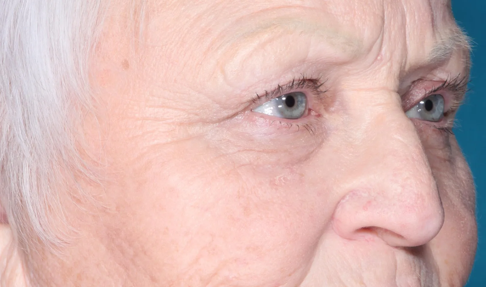 Before functional upper lid blepharoplasty case 5 at Skin Secrets
