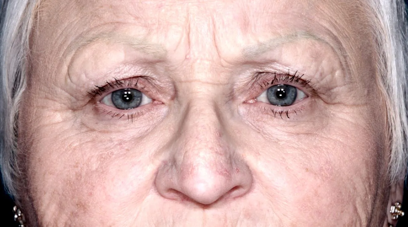 Before functional upper lid blepharoplasty case 5 at Skin Secrets