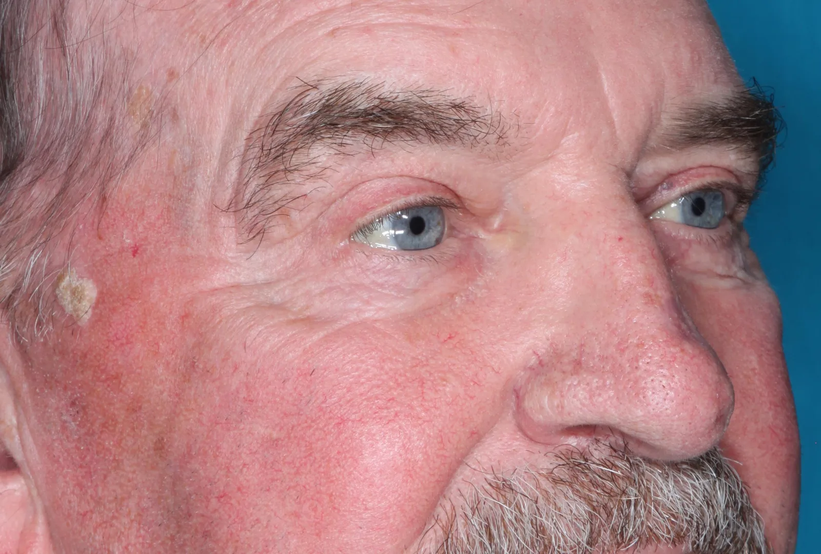 After functional upper lid blepharoplasty case 6 at Skin Secrets