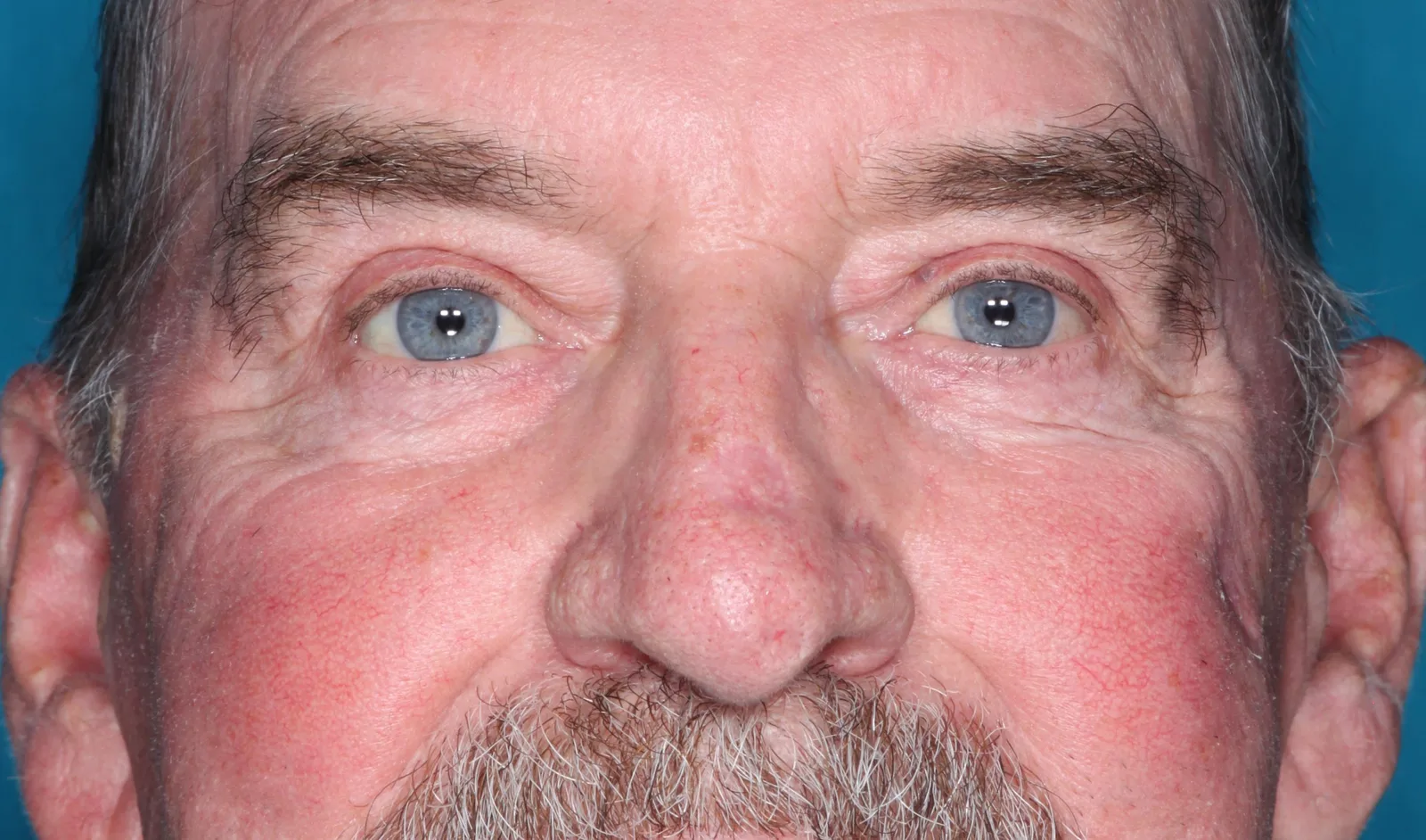 After functional upper lid blepharoplasty case 6 at Skin Secrets