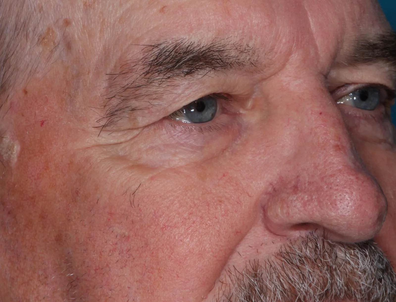 Before functional upper lid blepharoplasty case 6 at Skin Secrets