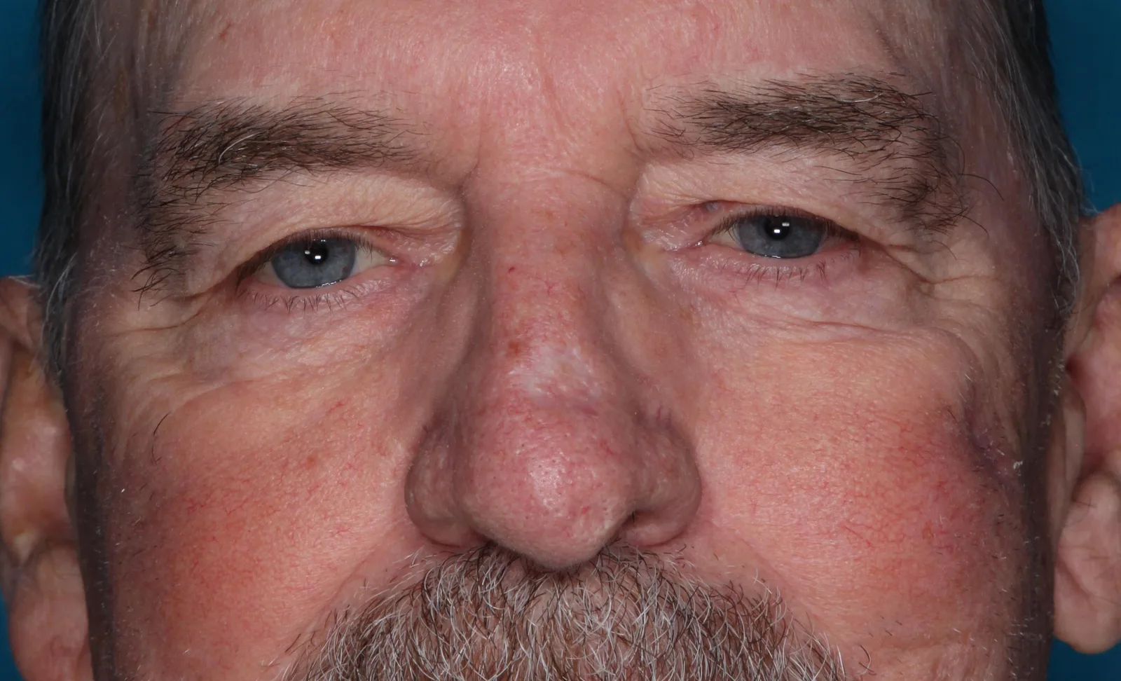 Before functional upper lid blepharoplasty case 6 at Skin Secrets