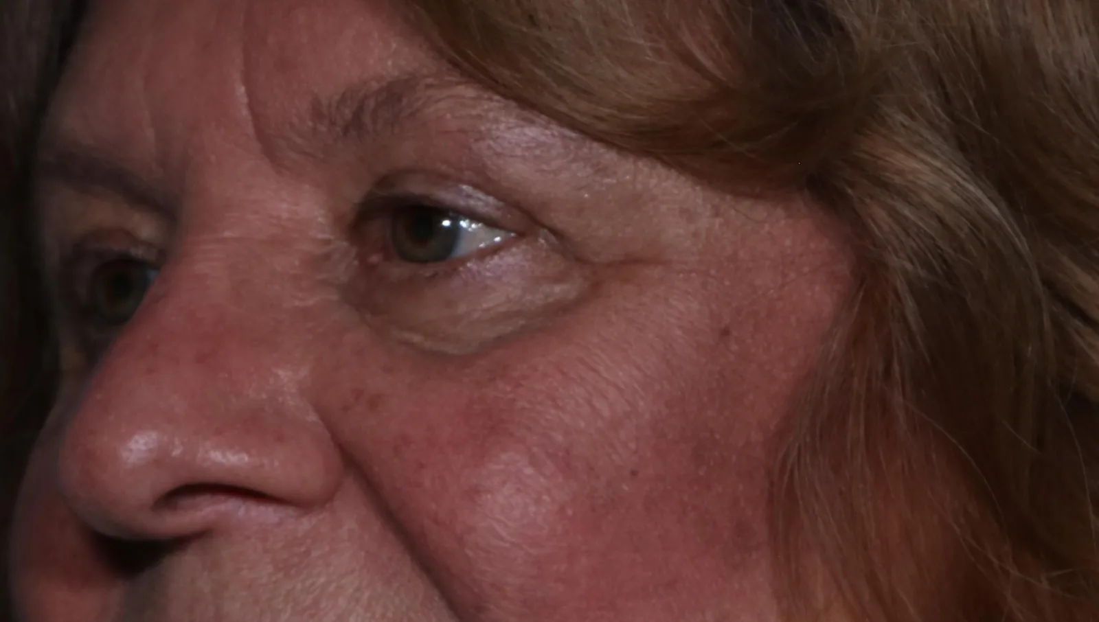 After functional upper lid blepharoplasty case 7 at Skin Secrets