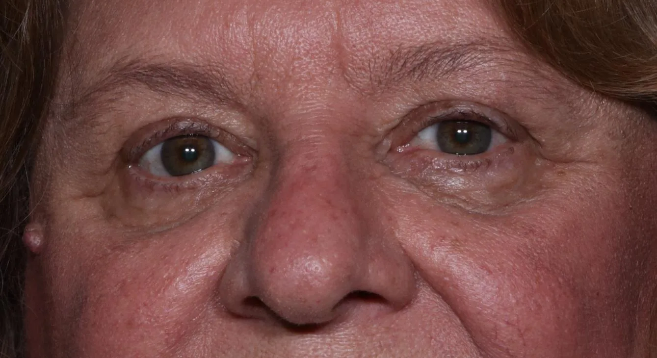 After functional upper lid blepharoplasty case 7 at Skin Secrets