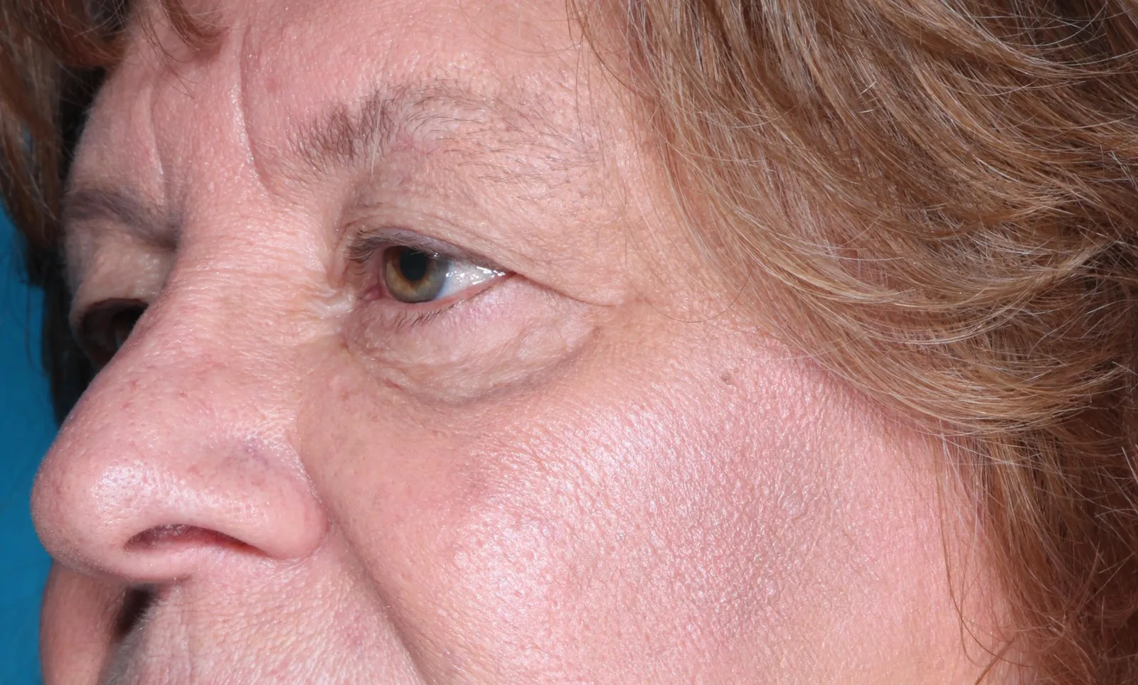 Before functional upper lid blepharoplasty case 7 at Skin Secrets