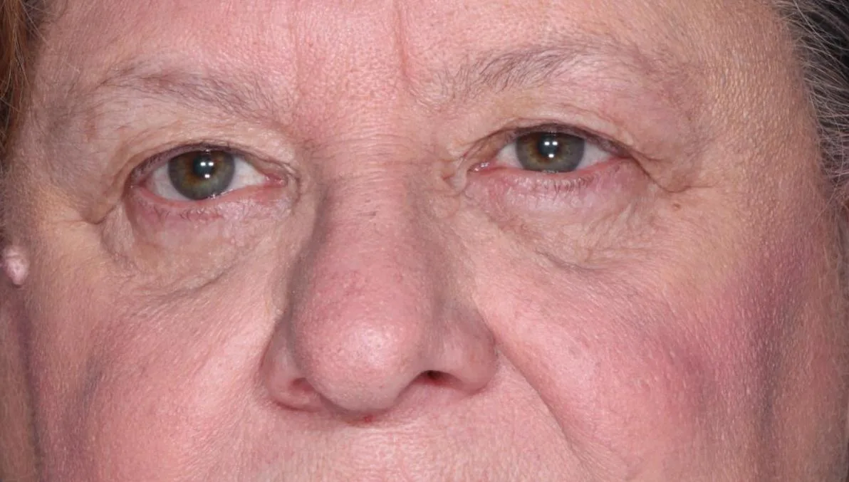 Before functional upper lid blepharoplasty case 7 at Skin Secrets