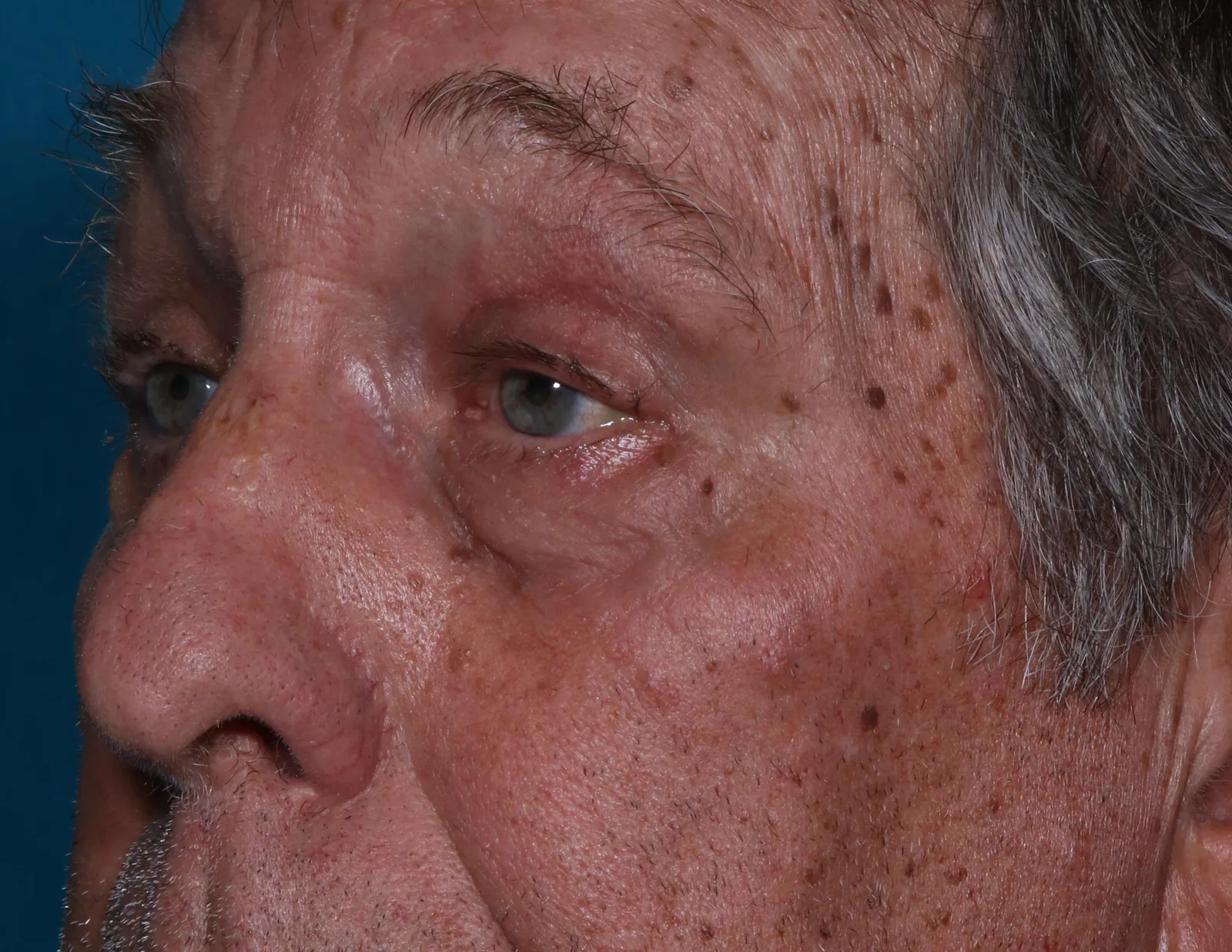 After functional upper lid blepharoplasty case 8 at Skin Secrets