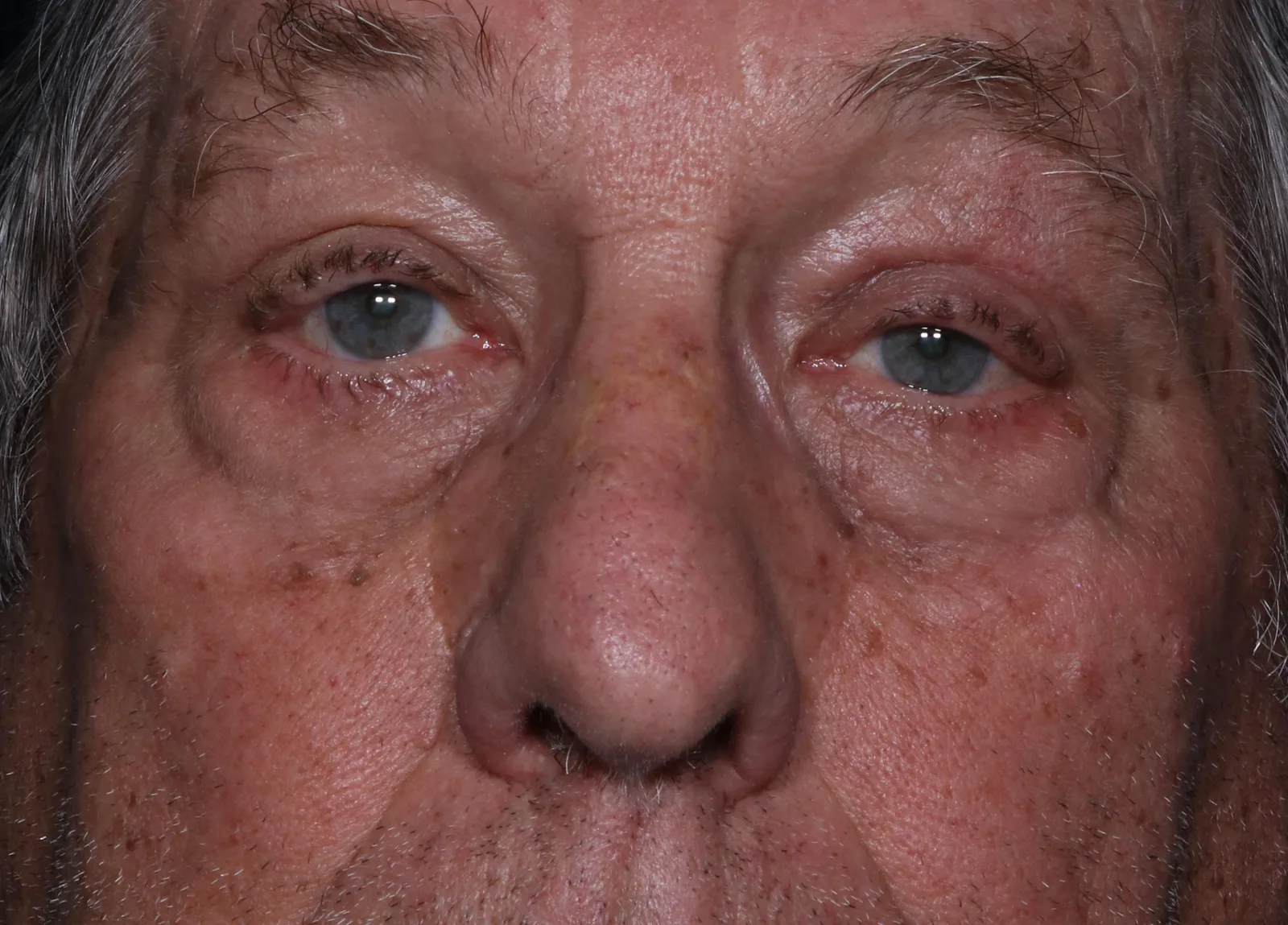 After functional upper lid blepharoplasty case 8 at Skin Secrets