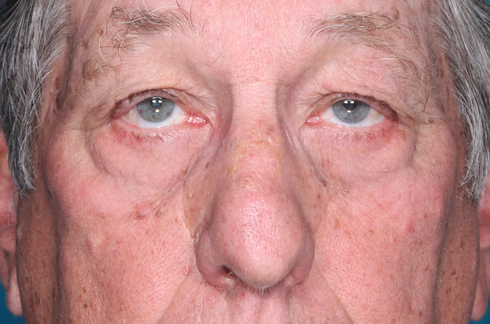 Before functional upper lid blepharoplasty case 8 at Skin Secrets