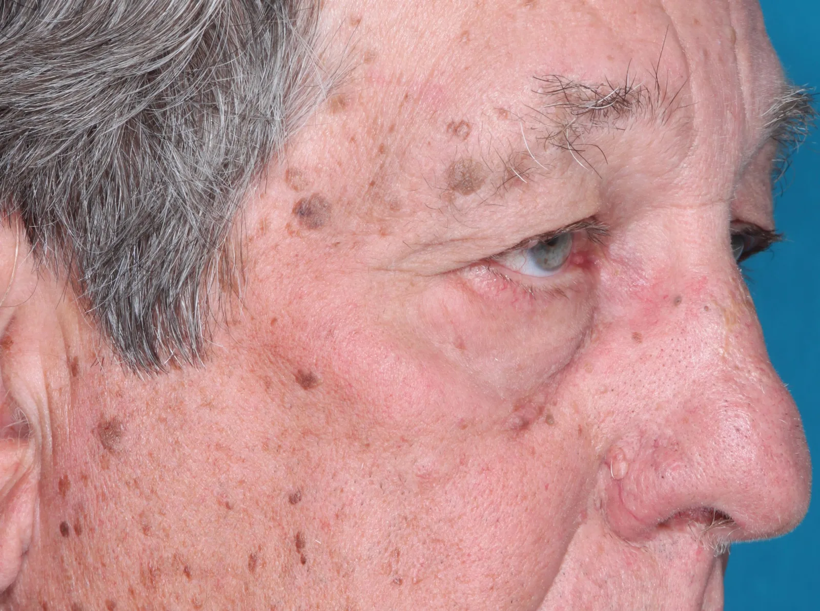 Before functional upper lid blepharoplasty case 8 at Skin Secrets