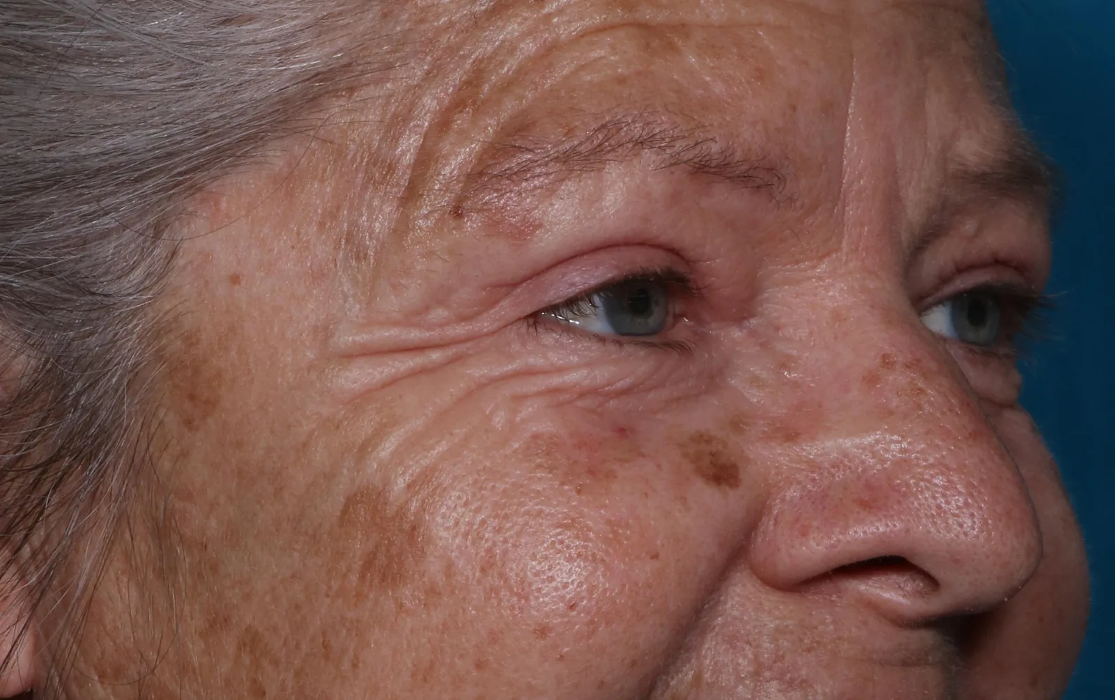 After functional upper lid blepharoplasty case 9 at Skin Secrets