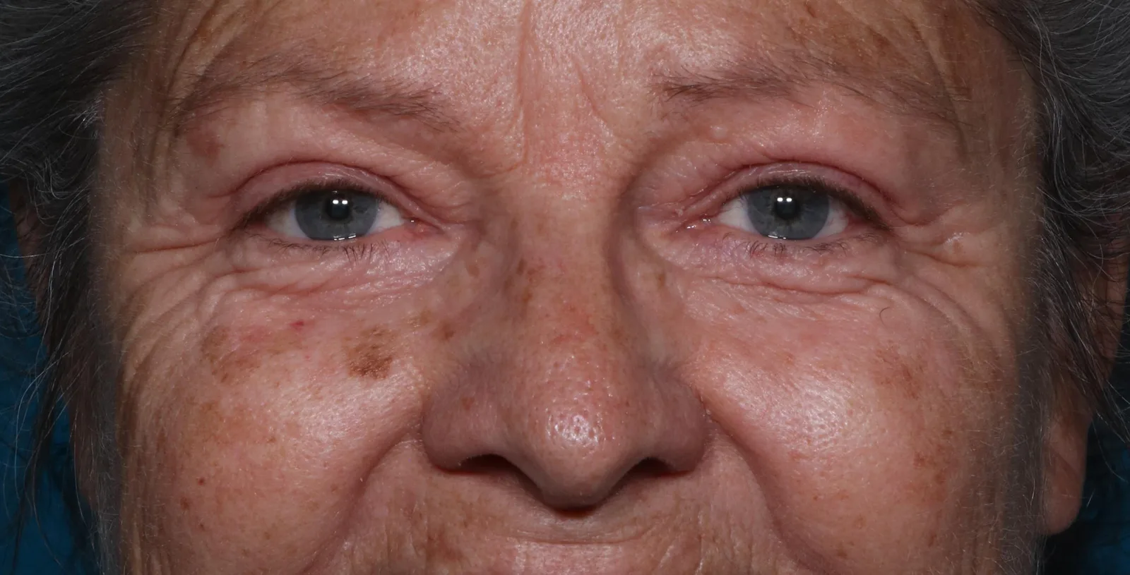 After functional upper lid blepharoplasty case 9 at Skin Secrets