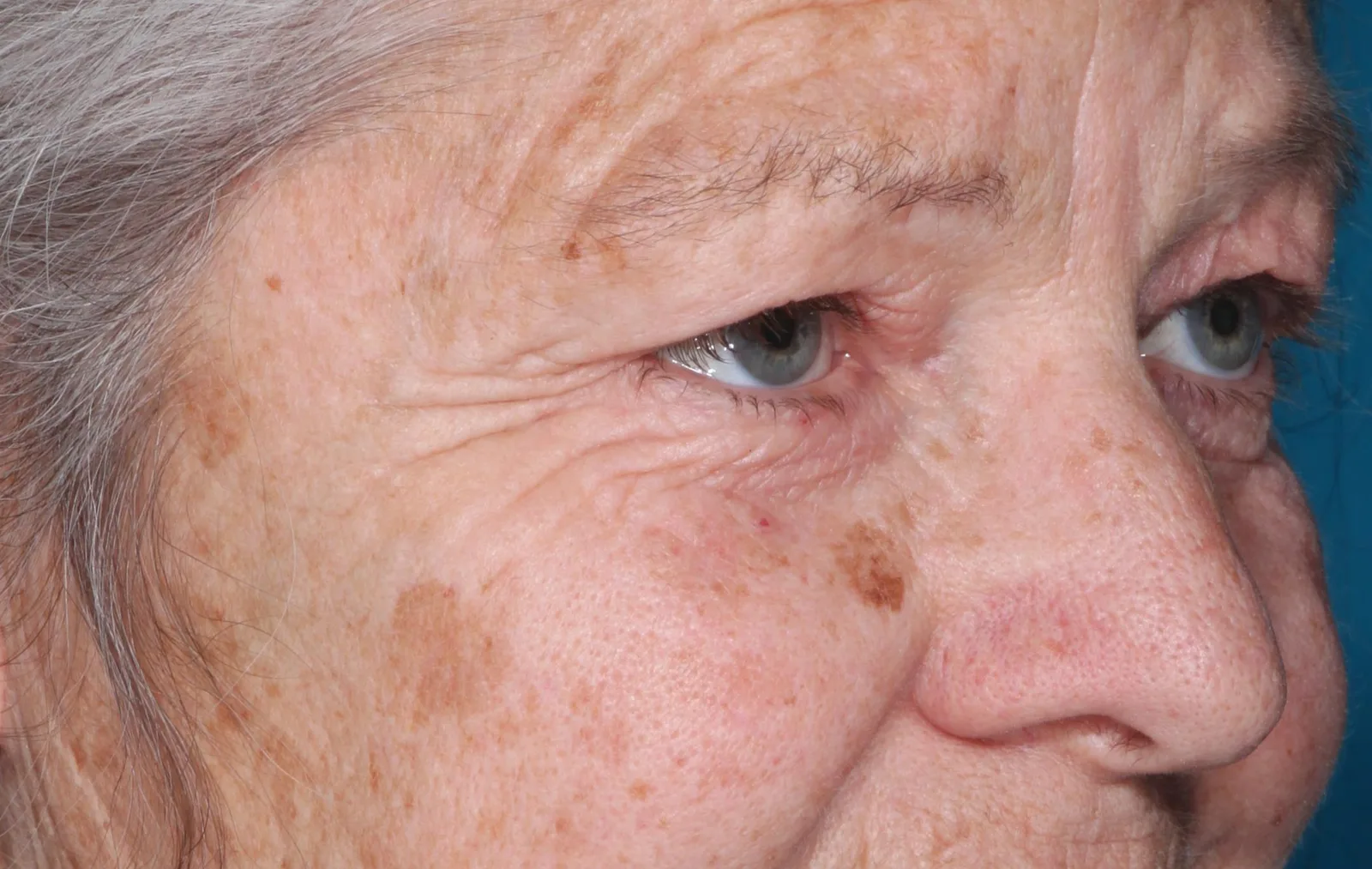 Before functional upper lid blepharoplasty case 9 at Skin Secrets